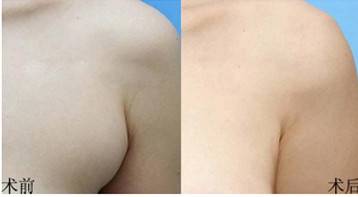 副乳严重图片胳肢窝图片