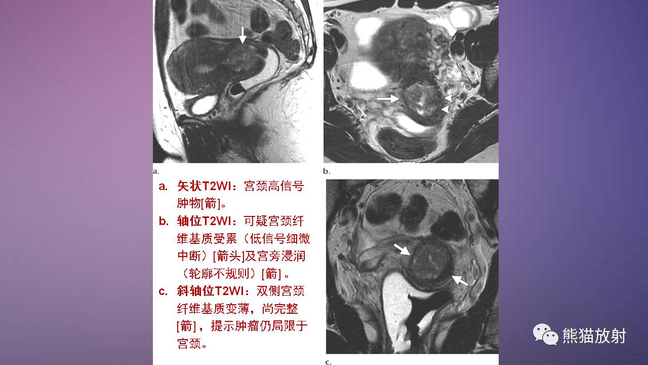 专题女性盆腔肿瘤的mri诊断