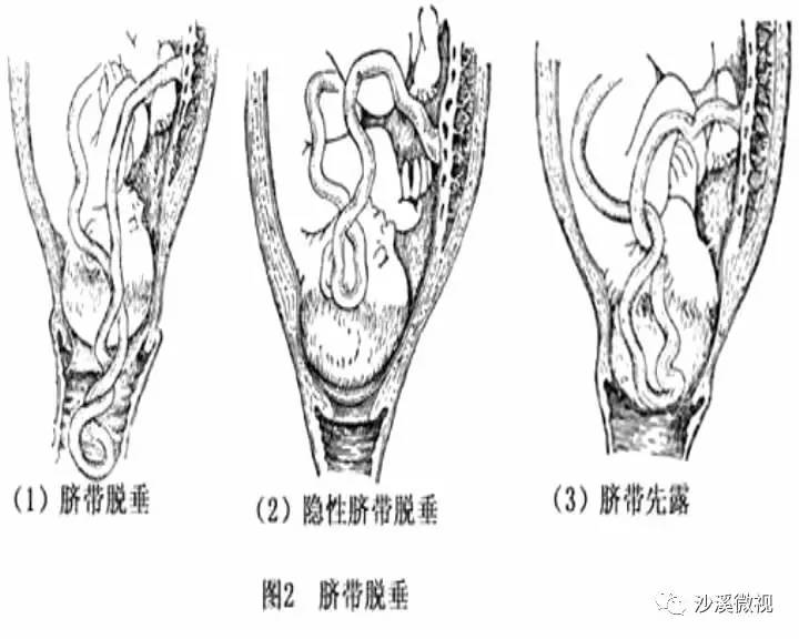 哪些人是脐带脱垂高危人群?又该怎样预防和处置?