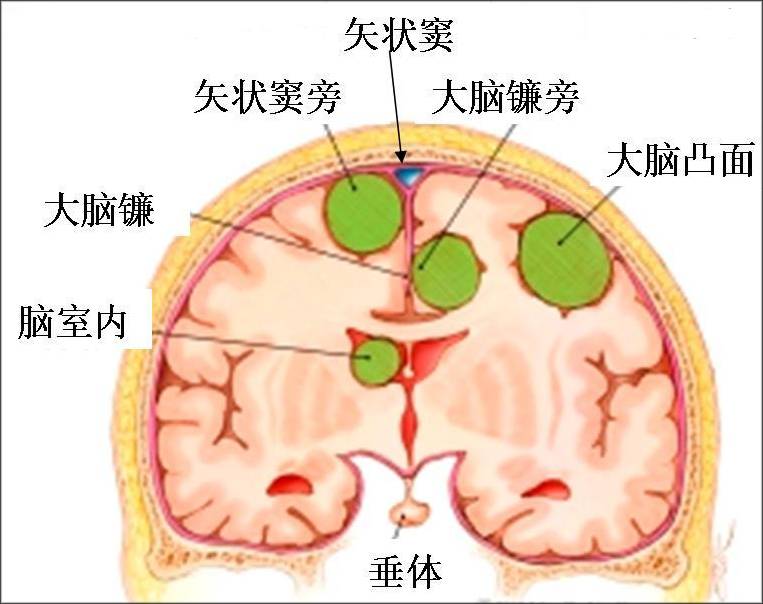 好发部位为大脑凸面,矢状窦旁,大脑镰旁,其次为蝶骨嵴,溴沟,鞍结节