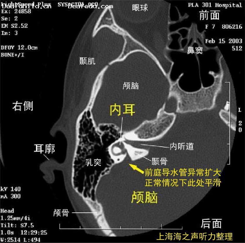 大前庭导水管综合症/前庭导水管扩大(lvas)