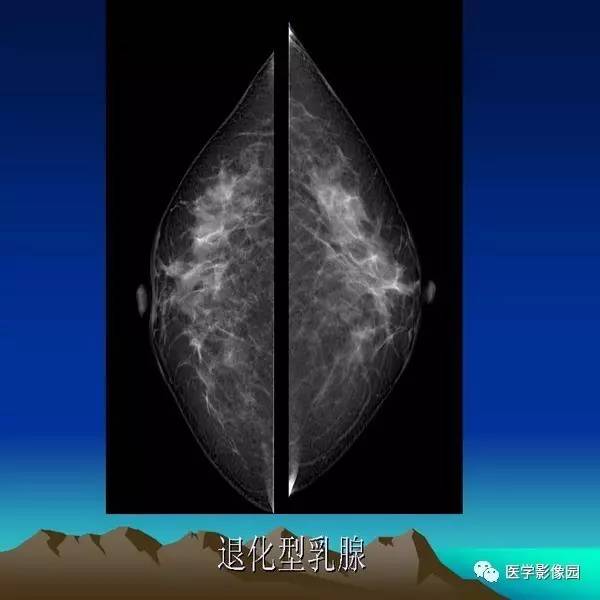 乳腺癌的鉬靶診斷丨影像天地