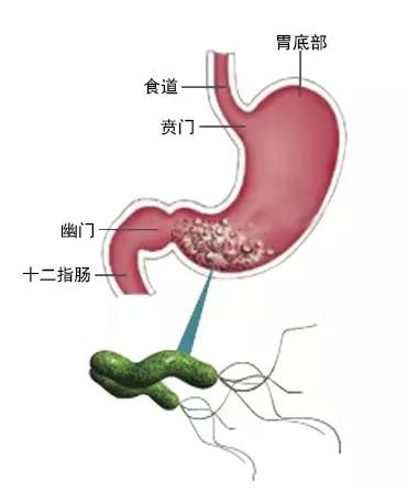 健康提醒胃癌元凶幽门螺杆菌您了解吗