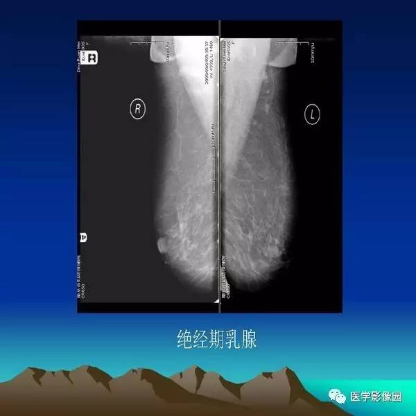 乳腺癌的鉬靶診斷丨影像天地