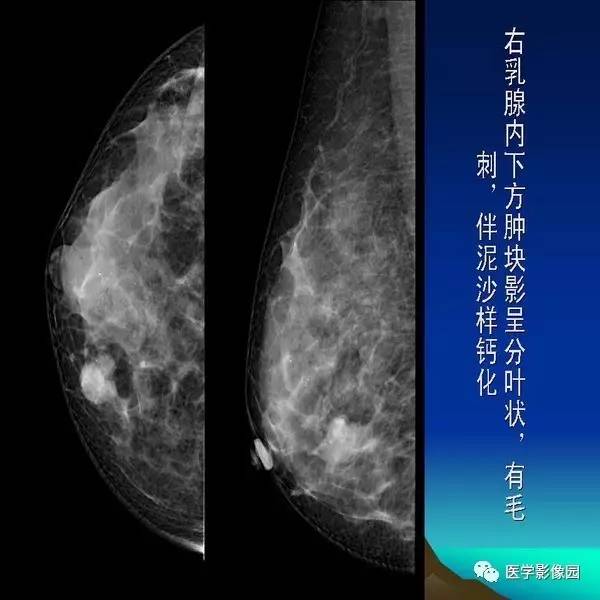 乳腺癌的鉬靶診斷丨影像天地