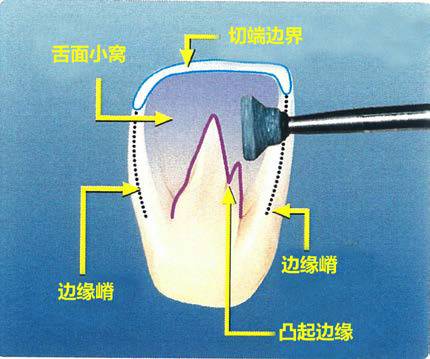 牙齿邻面接触点位置图片