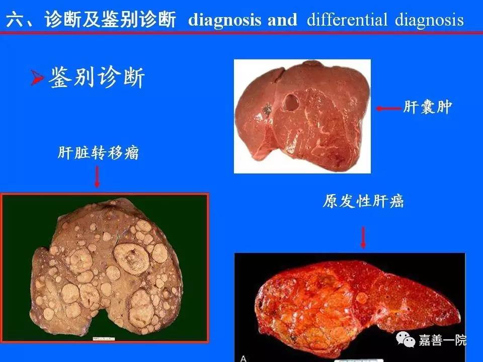 肝血管瘤介入治療微創有奇效