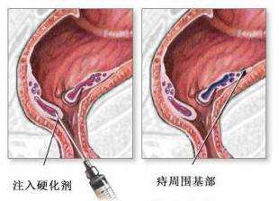 女性痔疮图片检查图片