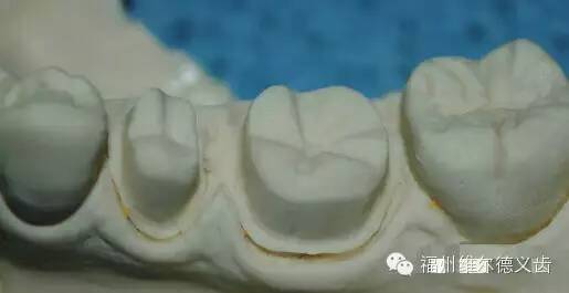 口腔修复医生备牙取摸常见问题系列之基牙倒凹与备牙时就位道的处理