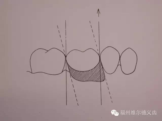 口腔修复医生备牙取摸常见问题系列之基牙倒凹与备牙时就位道的处理