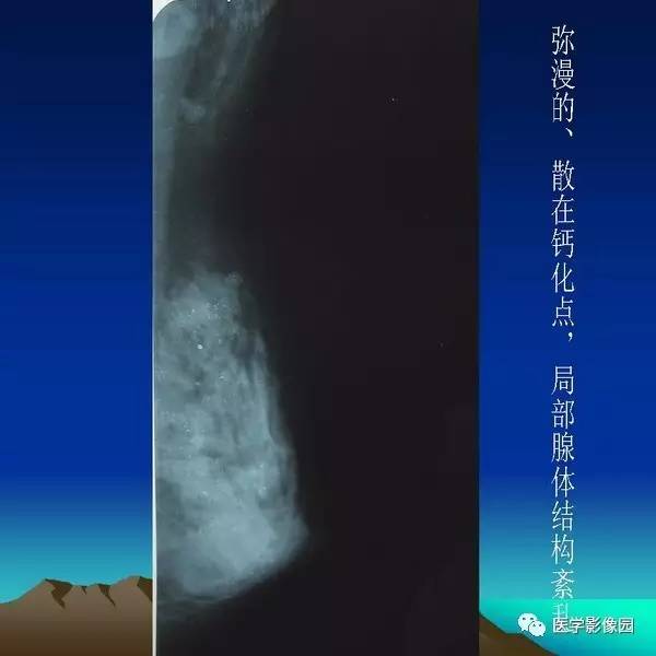 乳腺癌的鉬靶診斷丨影像天地