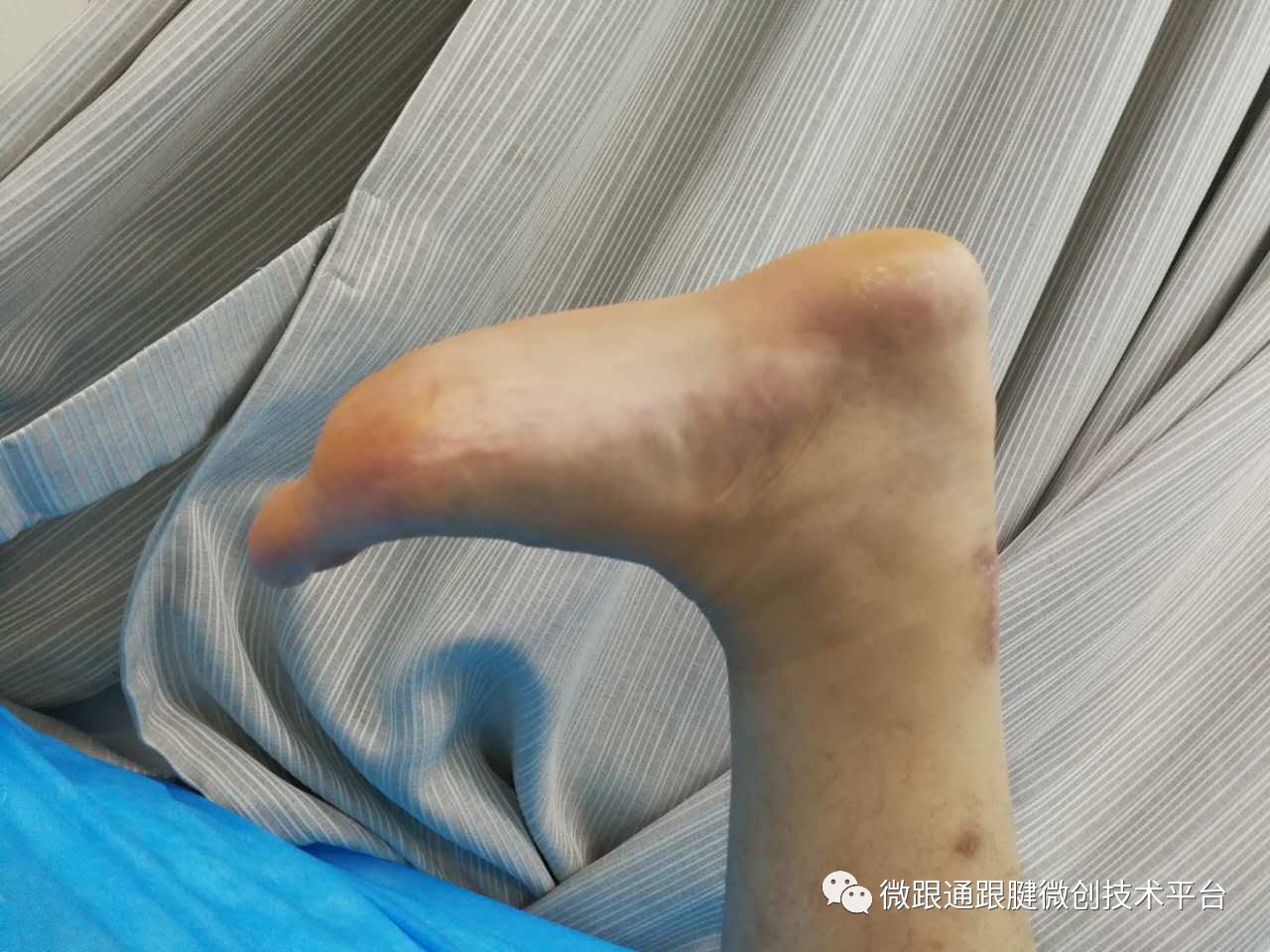 馬林主任為其行跟腱斷裂微創縫合手術,用時僅30分鐘,切口2cm.