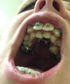 人的牙齿会像鲨鱼一样反复再生?