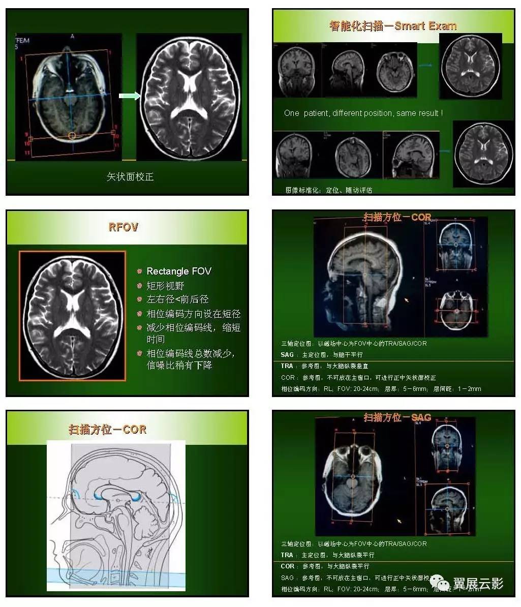 顱腦常規mri檢查方案及基本診斷方法