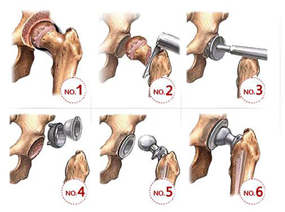 无柄髋关节置换图片图片