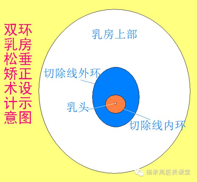 3,半环乳房松弛矫正术手术方法大致与双环相同,只是切口呈半环,切除