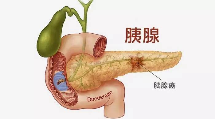 安靜的劊子手—胰腺癌