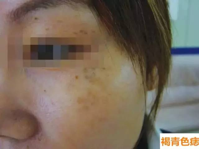 黃褐斑主要因女性內分泌失調,精神壓力大,各種疾病以及體內缺少維生素