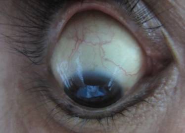 肝癌的眼睛图片图片