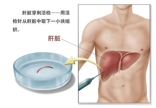 穿刺内衣_骨髓穿刺图片