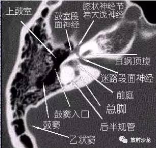 内耳ct解剖结构图图片