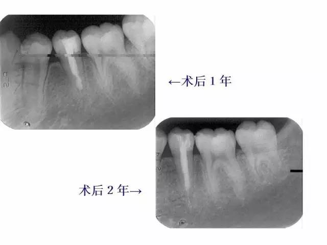 根尖诱导成形术