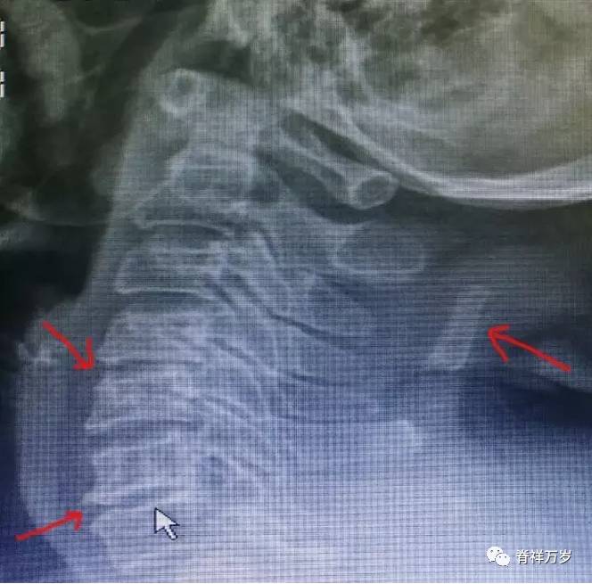 頸椎的改變為主,不易下頸椎病的診斷,如多個椎間隙狹窄和項韌帶鈣化