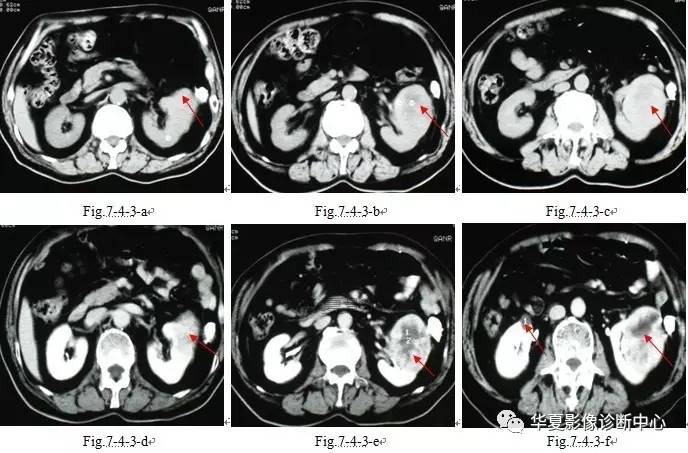 有圖有真像腎臟惡性腫瘤的ct表現