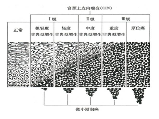 谈谈宫颈病变诊治「三步曲」