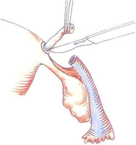 开腹输卵管结扎术高清图片