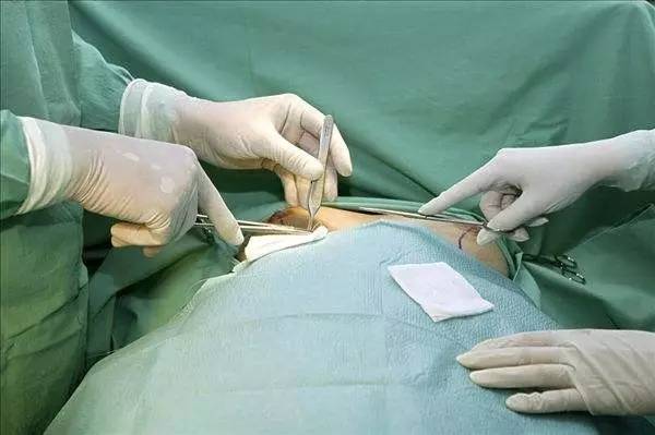 乳房手术全过程 引流图片