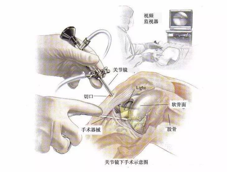 關節鏡微創手術小切口解決大問題