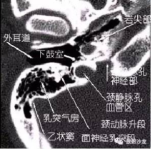 乙状窦解剖图ct图图片