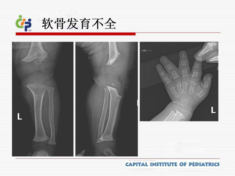 软骨发育不全,假性软骨发育不全,脊柱骨骺发育不良(先天型/晚发型)