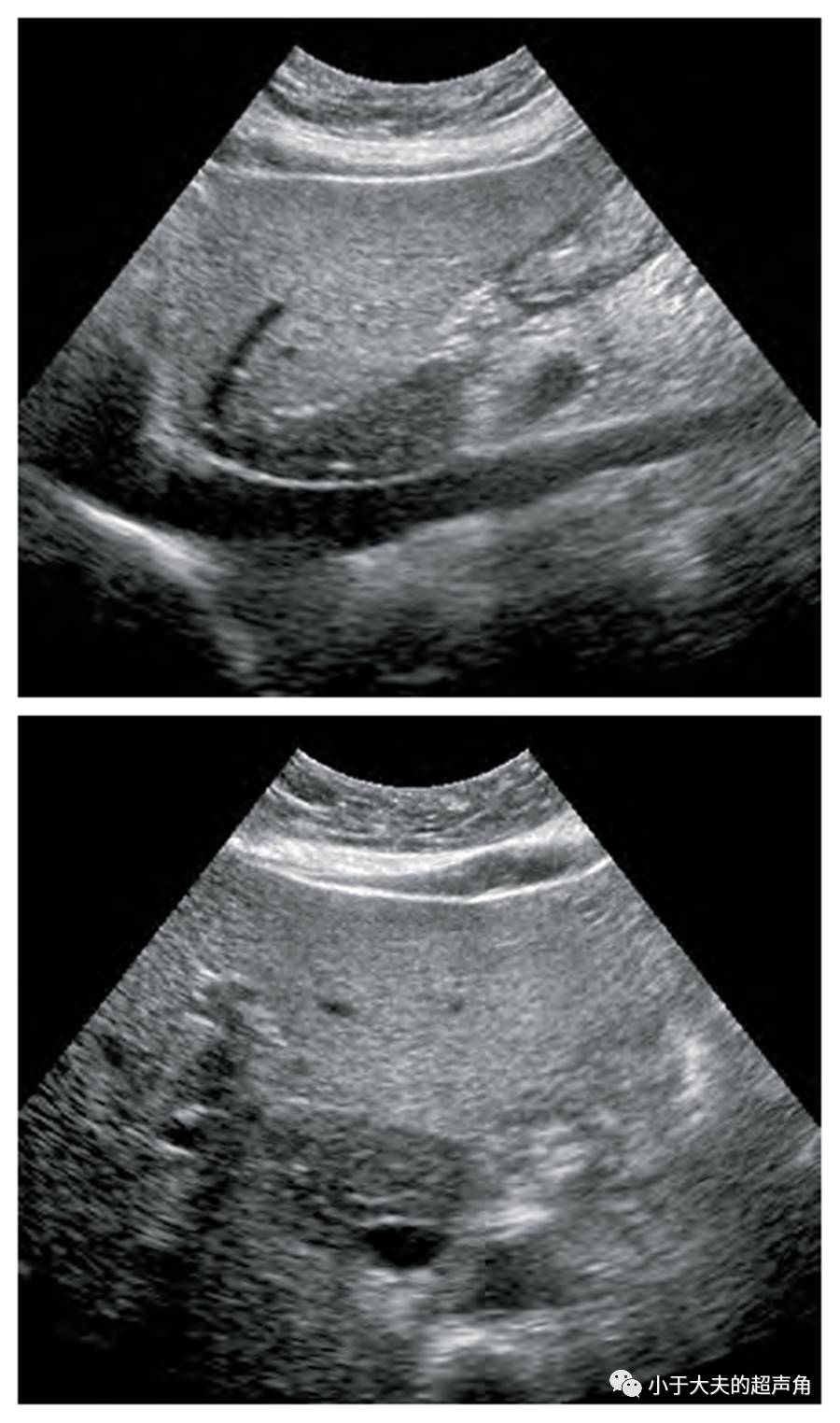 脂肪肝声像图改变图片