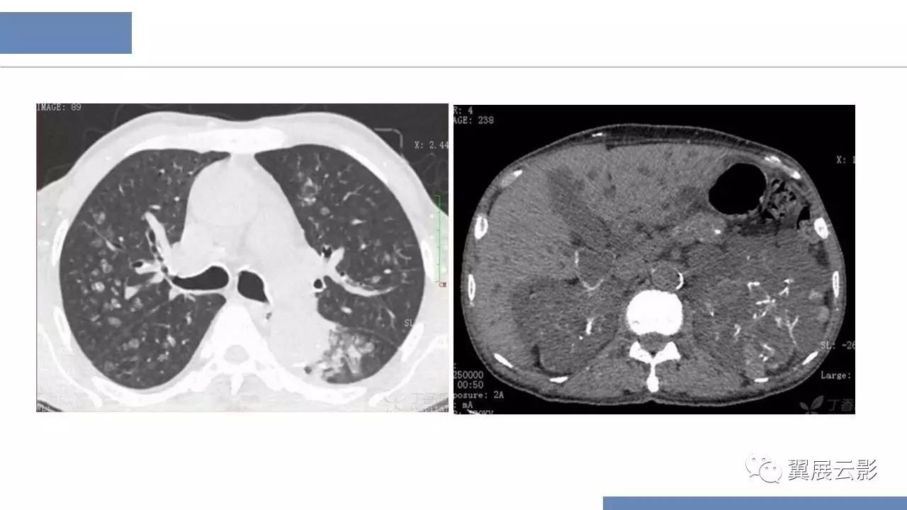 肺转移性钙化(肺钙化)