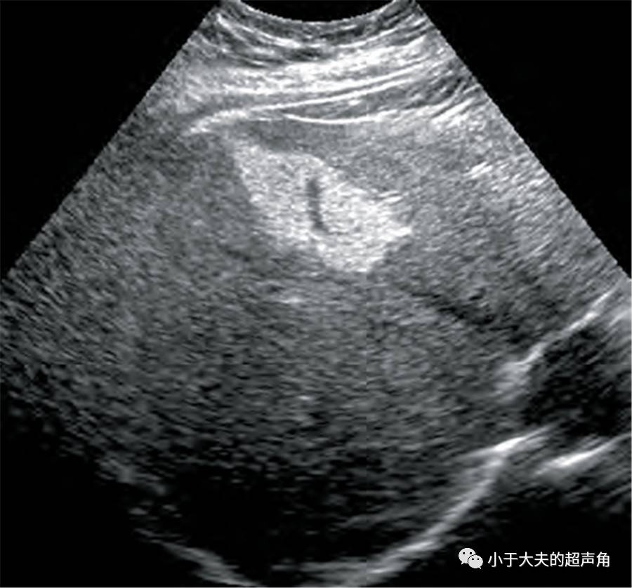 脂肪肝声像图改变图片