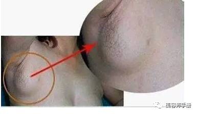 副乳和淋巴结的区别图图片