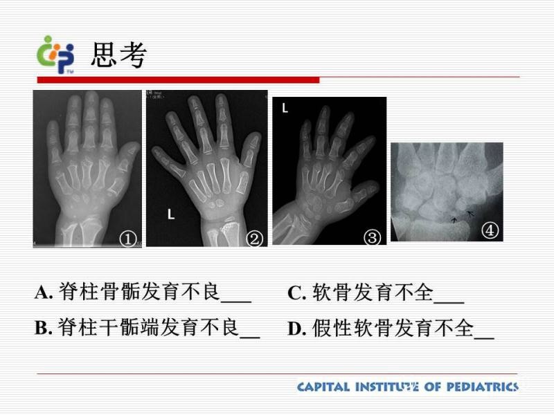 一脉影像课堂骨软骨发育障碍怎么看儿研所专家帮您指点迷津