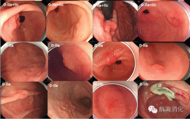 胃癌胃镜图片 彩色图片