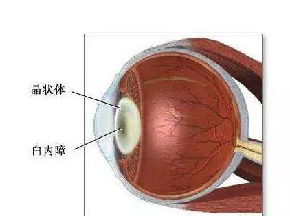 的難治性青光眼,它的臨床特點是在原發性眼病基礎上虹膜出現新生血管