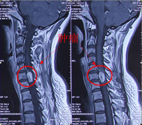 病例:高颈段神经鞘瘤一例