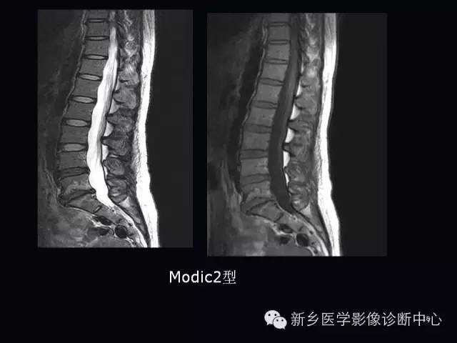 腰椎终板炎的mr分型