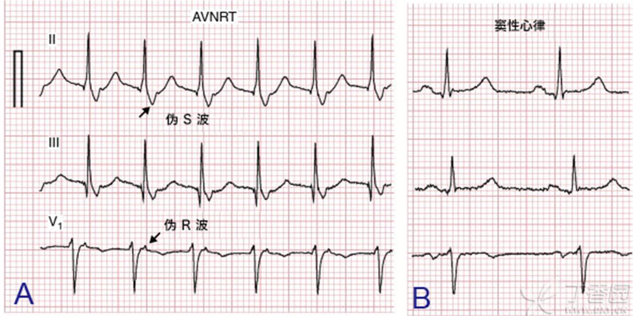 房扑心电图 室上速图片