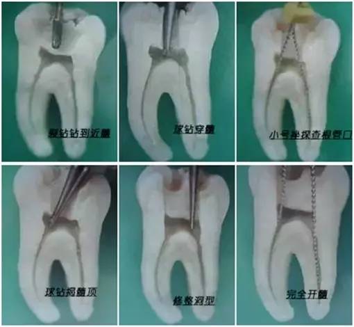 右下六开髓根管图片图片