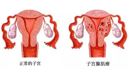 子宫腺肌症因为生气图片