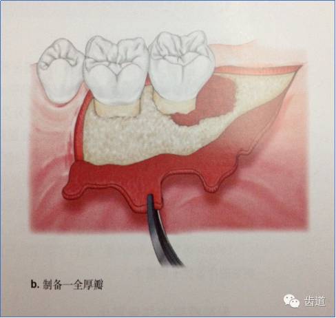 内斜切口,保留龈乳头切口等,但要注意以尽量保留较多的角化牙龈组织为