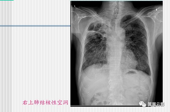 肺结核的影像学诊断