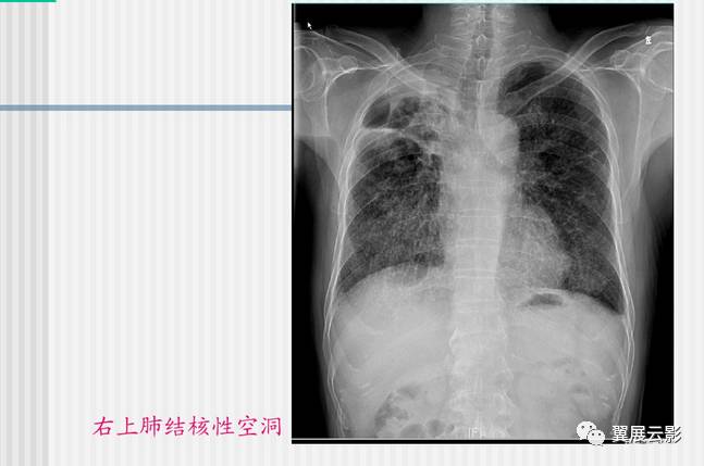 原发性肺结核x线图片