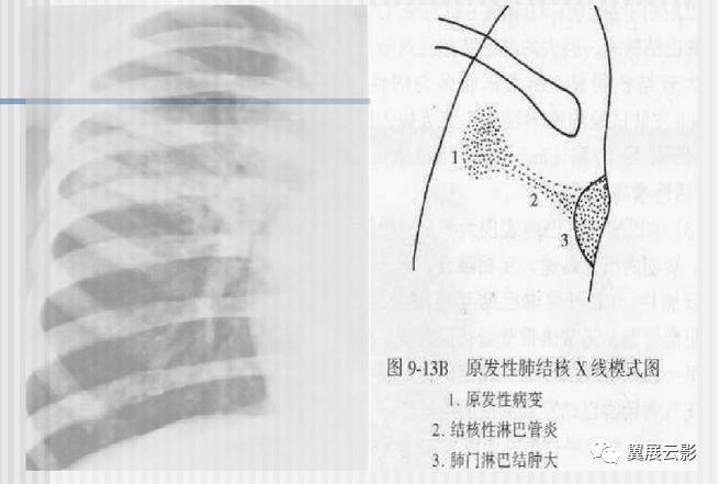 肺结核的影像学诊断